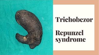 Trichobezoar Repunzel Syndrome - Dr Praveen Patil