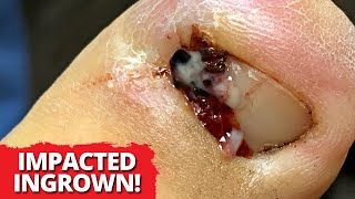 One Month Old DEEP Ingrown Nail Removal!