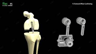JUST MED_Surgical Technique Animation_RSK® PS High Flexion Hybrid Revision Knee System