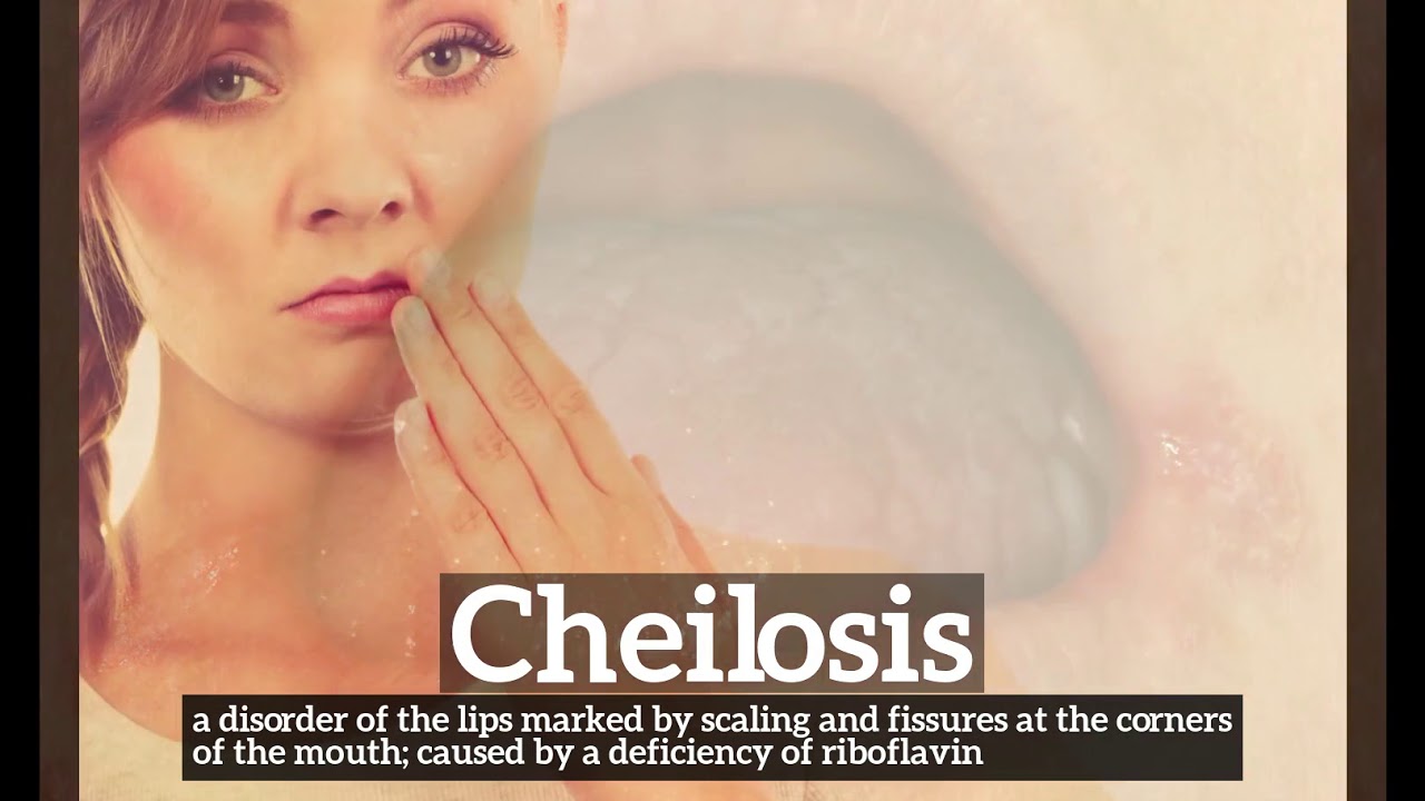 How Does Cheilosis Look? What is Cheilosis? How to Say Cheilosis in