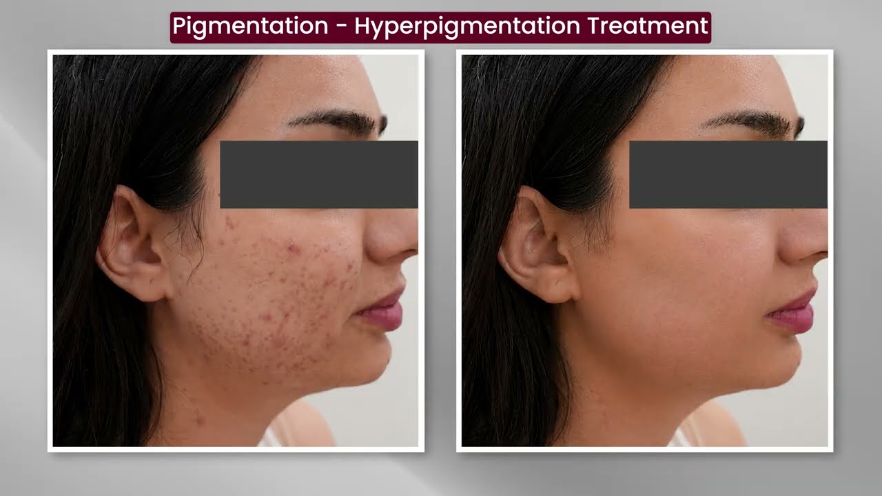 Best Pigmentation Treatment in Dubai | RF Microneedling, Chemical Peel & Q-Switch Laser