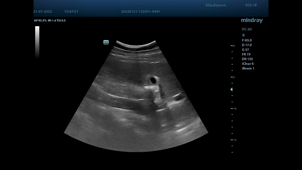 Печень на УЗИ Mindray DC-80