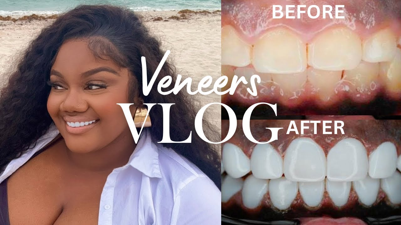 NEW SMILE REVEAL!! $5500 On Composite Resin Veneers By DENTAL DESIGN SMILE MIAMI