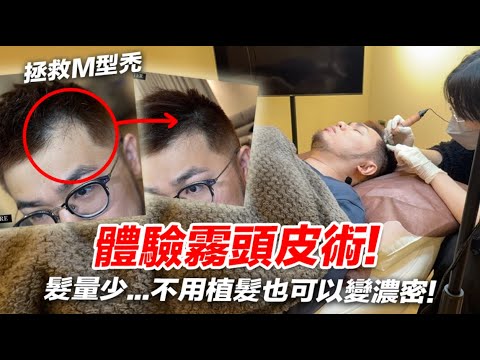 體驗霧頭皮術！髮量少M型禿也可以變濃密？【狸貓】