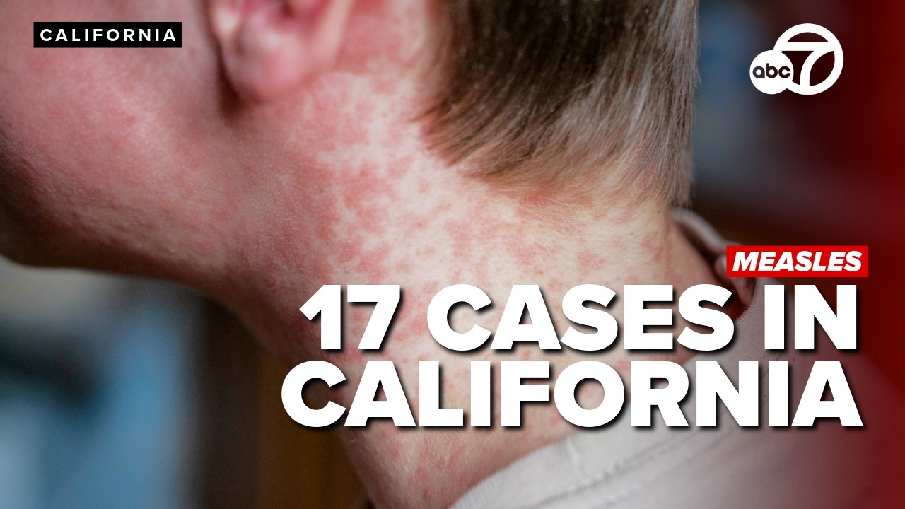 Как узнать, защищены ли вы от кори