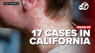 How To Know If You Are Protected Against The Measles