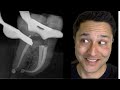 How to Get Down Super Curved Root Canals