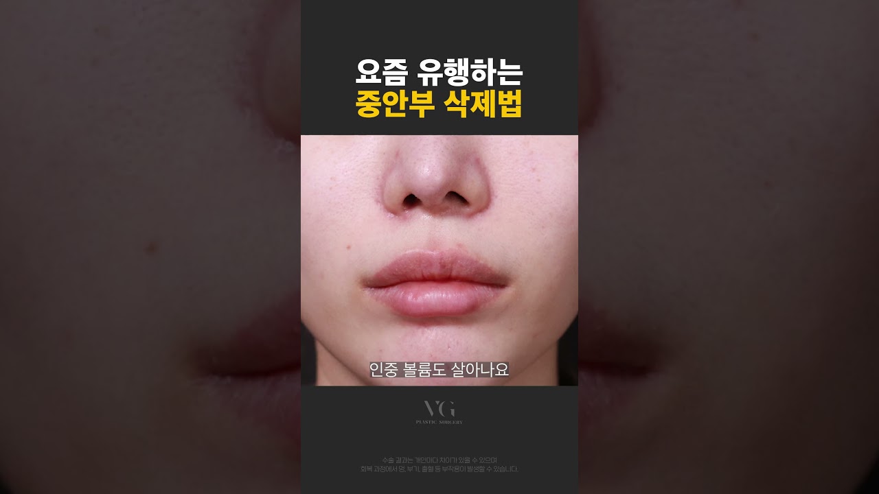 [貝麗古德整形外科診所] 最近流行的中面部刪除法。