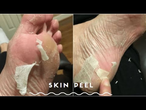 I TRIED A GROSS FOOT PEEL - CLICKBAIT - 동영상