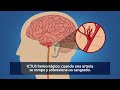 ICTUS, infarto, derrame cerebral qué lo diferencia