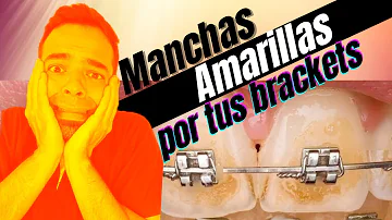 ¿Por qué mis dientes se vuelven amarillos con los aparatos de ortodoncia?