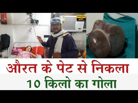 गोपालगंज में हमारे हॉस्पिटल में पेट से लगभग 10 किलो की गांठ निकाली गई