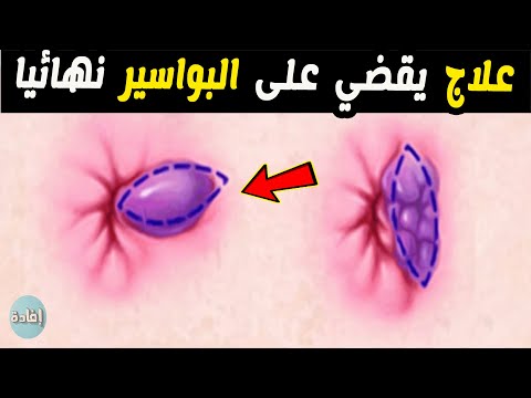 افضل علاج يقضي على البواسير نهائيا