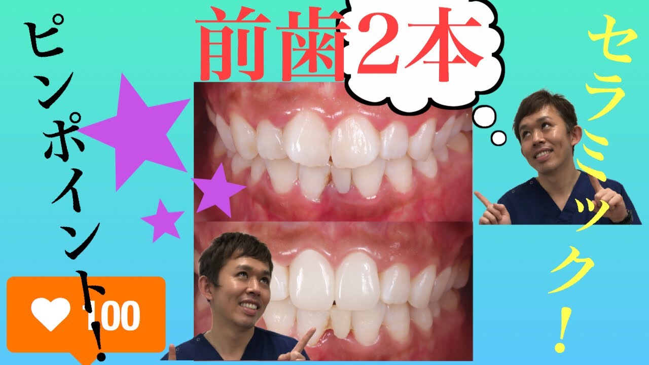湘南美容歯科福岡院 セラミック矯正 その日に変わるone Dayスピードセラミック 仮歯 ダイヤモンドセラミック ファイナル Youtube