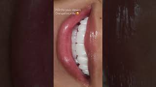 Stunning porcelain veneers by Dr. Charlie #porcelain #veneers #porcelainveneers