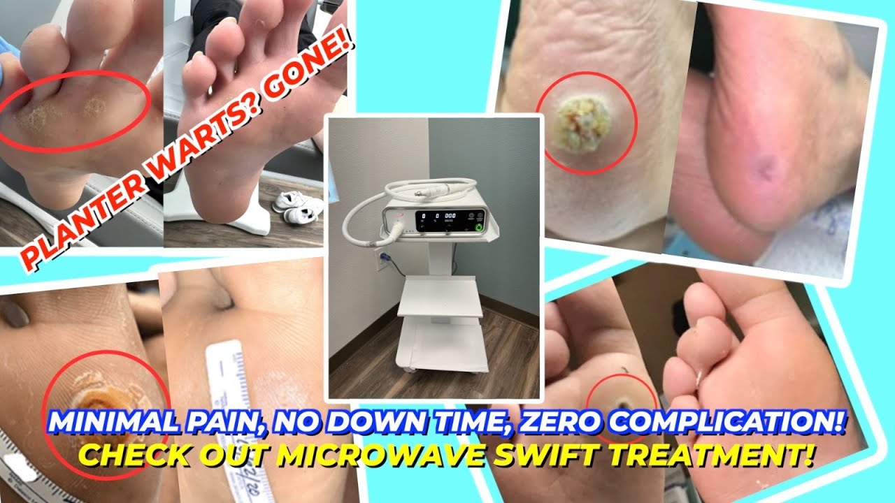 Plantar Warts Part 3 New Microwave Treatment for Plantar Warts? YouTube
