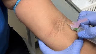 HOW TO REDIRECT THE NEEDLE  TOWARDS THE VEIN AFTER MISSING THE VEIN(NO TALKING) Resimi