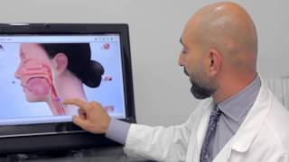 TransOral Laser for the Treatment of Zenker’s Diverticulum | Dr. Babak Larian in Los Angeles