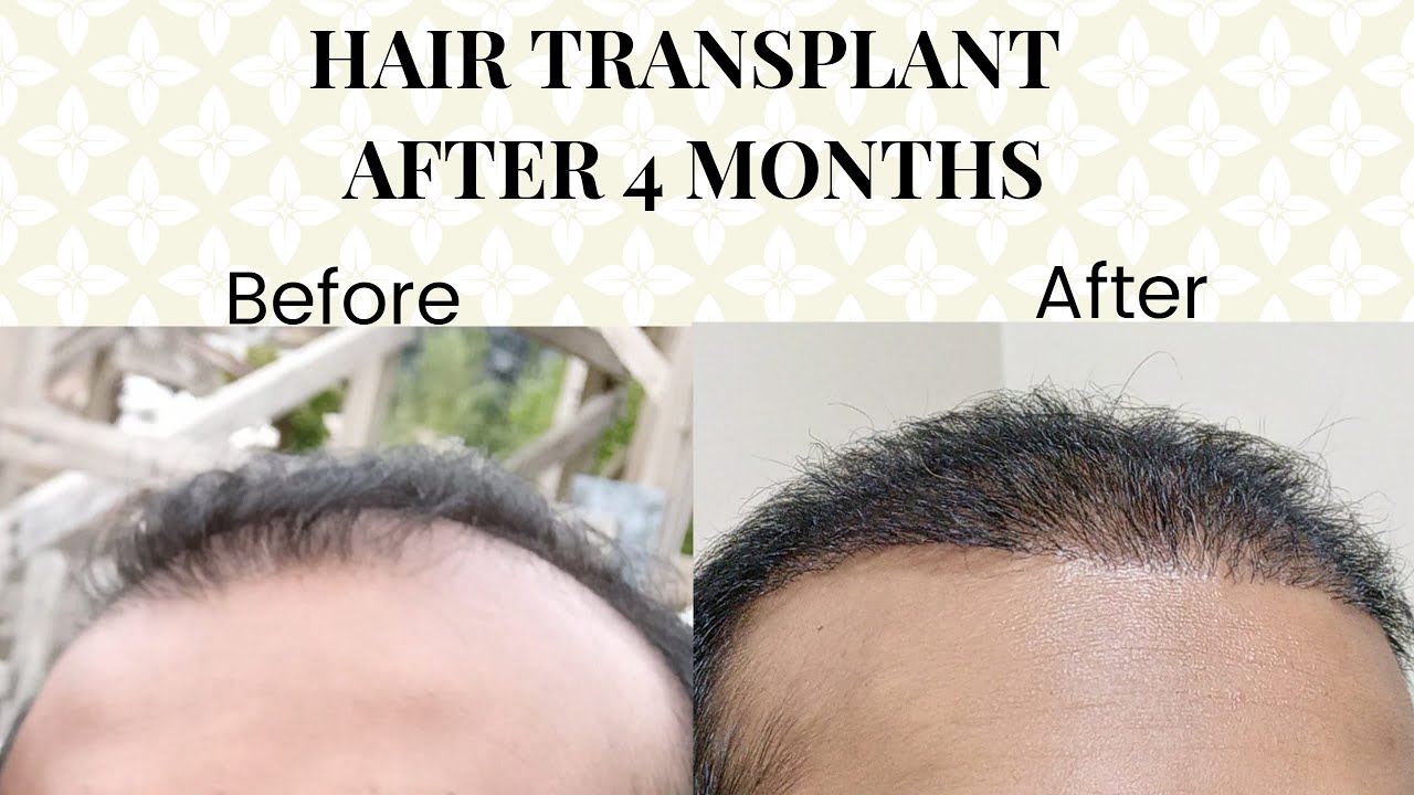 4 Months Post Hair Transplant  We Grow Hair Indy