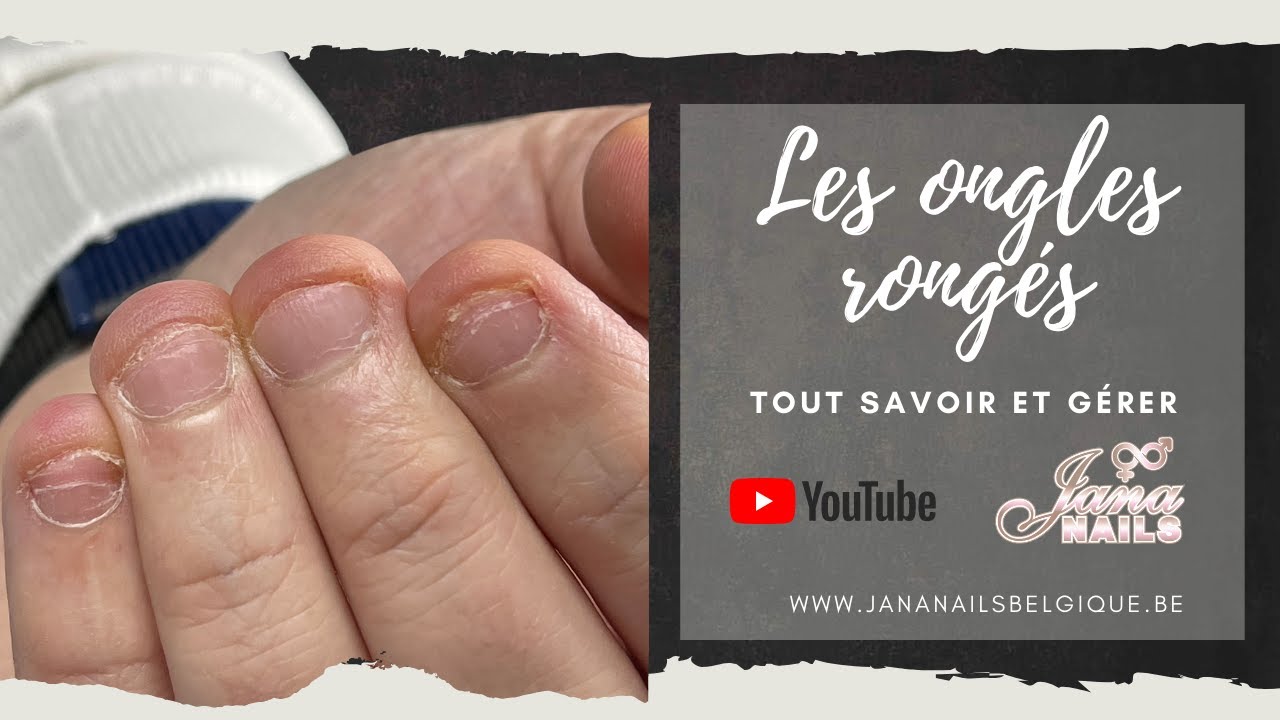 Les ongles rongés, tout savoir et gérer 😃💪