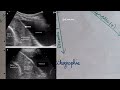 Obstétrique path : placenta preavia 😣💥