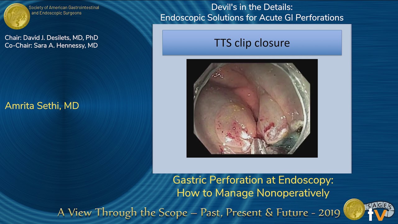 Gastric Perforation at Endoscopy How to Manage Nonoperatively YouTube
