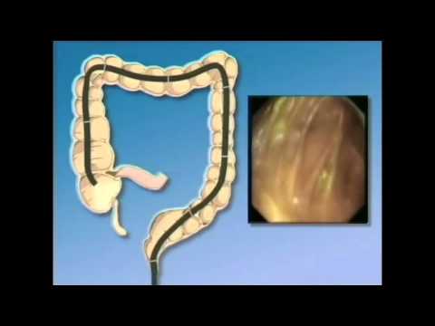 Schematische Darstellung einer Koloskopie mit Livebild - YouTube