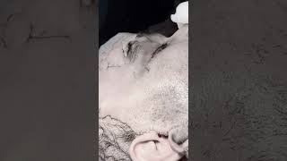 Facelift Surgery