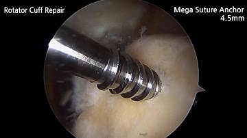 Rotator Cuff Repair_ ARC Mega Suture Anchor