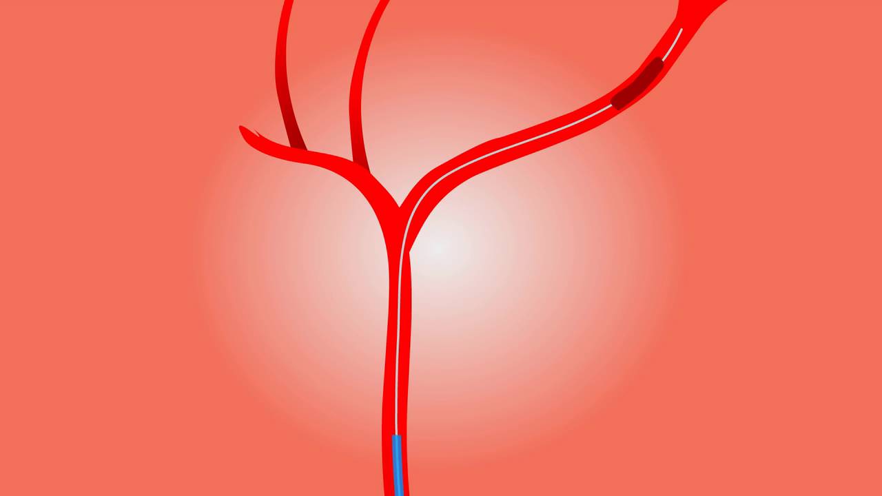 simulation of Brain injury operation