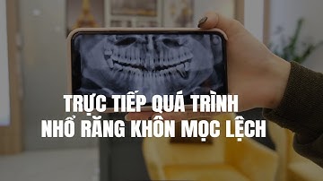 TRỰC TIẾP QUÁ TRÌNH NHỔ RĂNG KHÔN MỌC LỆCH CHO ANH TÙNG