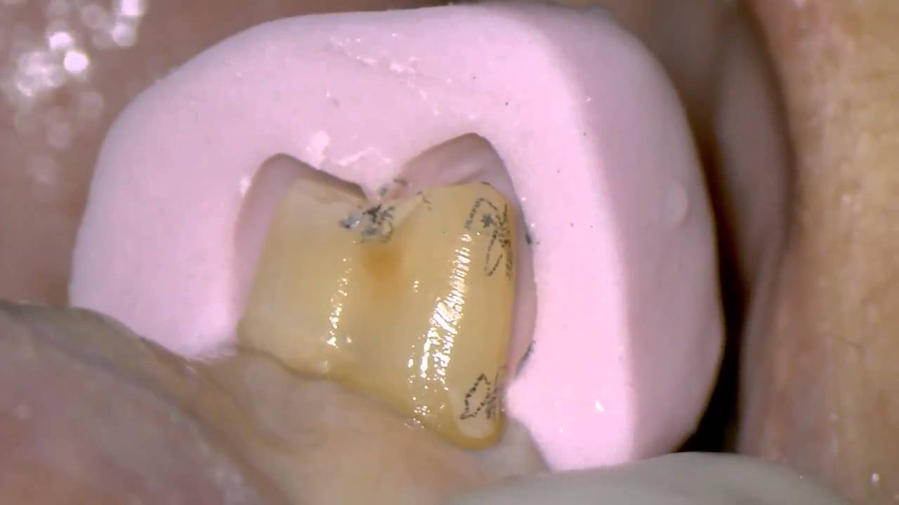 Tooth preparation of right premolar with microscope YouTube