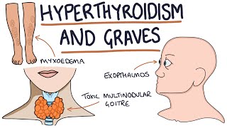 Understanding Hyperthyroidism and Graves Disease screenshot 4