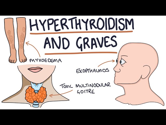 Understanding Hyperthyroidism and Graves Disease class=