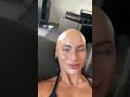 WHAT IN THE ALOPECIA IS GOING ON #hairgrowth #alopecia #alopeciaawareness #bald #hairregrowth