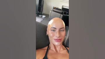 WHAT IN THE ALOPECIA IS GOING ON #hairgrowth #alopecia #alopeciaawareness #bald #hairregrowth