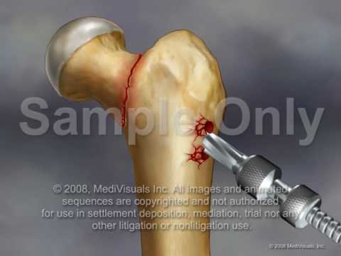 thesis on fracture neck femur thesis on fracture neck femur