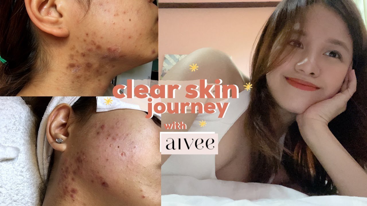 How I cleared my adult acne *lots of pics* | my skin story w the Aivee ...