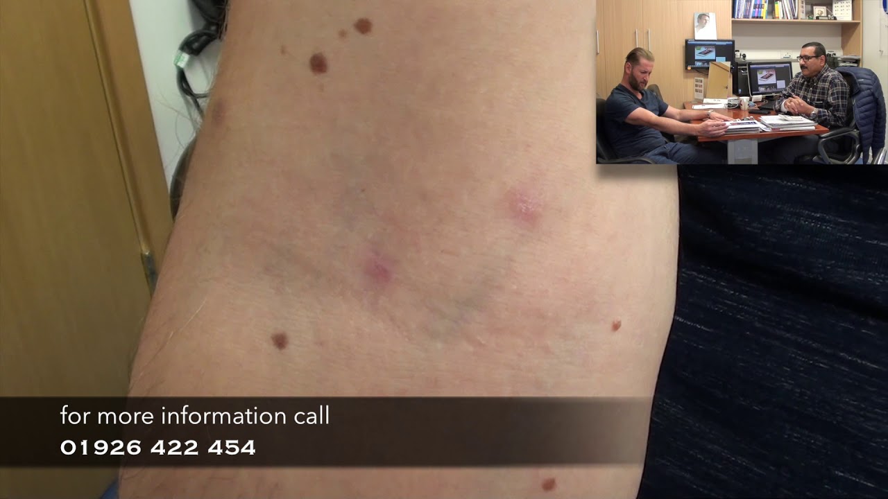 Dr Jha Mole Removal YouTube