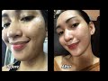 PART 2 : HOW TO REMOVE WARTS/SKIN TAGS!!? FOR ONLY 1,500 PESOS UNLIMITED NA!!!!