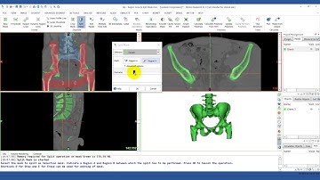 How to Use the Split Mask Tool in Mimics | Mimics Innovation Suite | Materialise Medical
