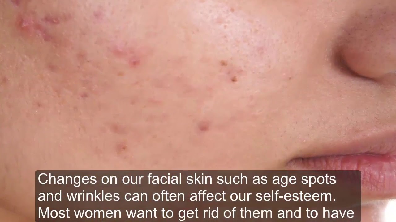 Use Apple Cider Vinegar And Baking Soda Mask To Remove Acne Scars And