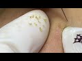 Clean Blackheads Easy | Loại Sạch Mụn Đầu Đen Dể Dàng - SacDepSpa#185