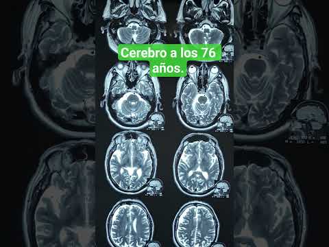 ✅️ Cerebro a los 76 años. #music #health #brain #thinking