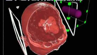 Virtual Surgery Technical Demo