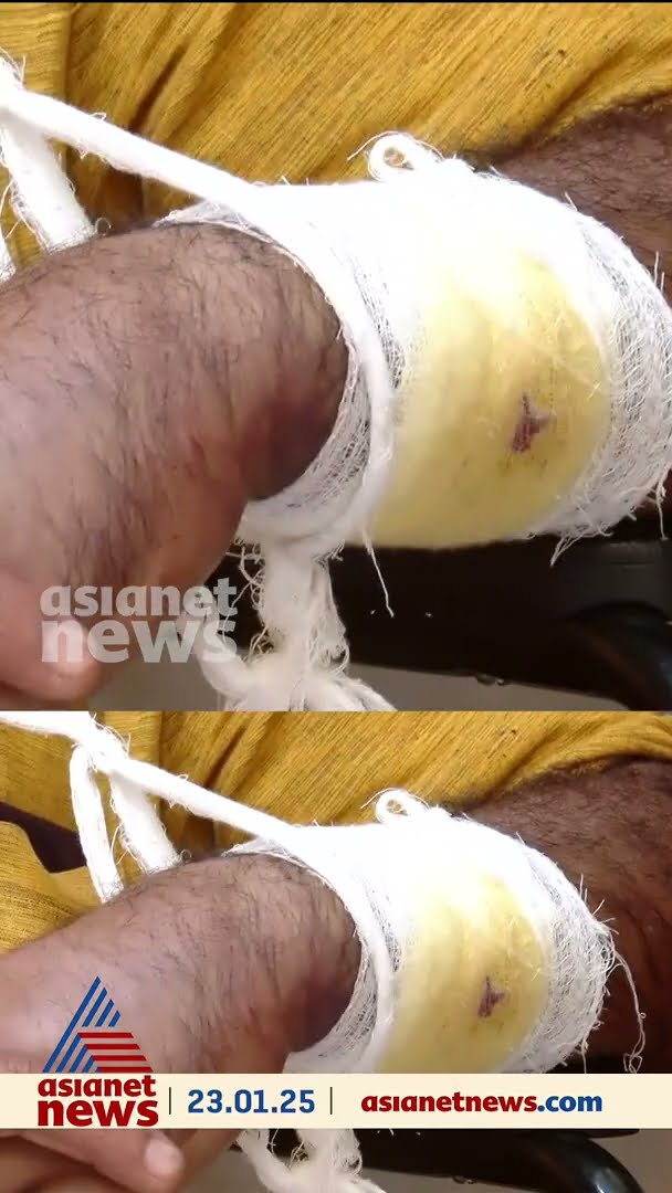 അവിശ്വാസ പ്രമേയത്തെ അനുകൂലിച്ചു, പഞ്ചായത്ത് അംഗത്തിന്‍റെ കൈ തല്ലിയൊടിച്ചു