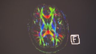 Celebrity Rethinking recovery: New concussion treatment helps young athletes heal faster Wealth