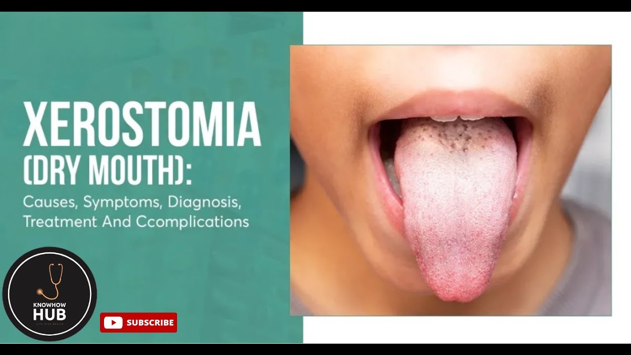 Xerostomia Causes Symptoms And Treatments Knowhow Hub YouTube xerostomia-causes-symptoms-and-treatments-knowhow-hub-youtube