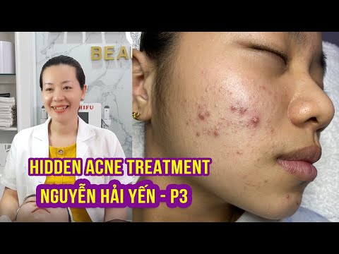 Hidden Acne I Điều trị mụn hiệu quả số 1 tại Hiền Vân Spa INguyễn Hải Yến IPart 3I 517 Hidden Acne I Điều trị mụn hiệu quả số 1 tại Hiền Vân Spa INguyễn Hải Yến IPart 3I 517