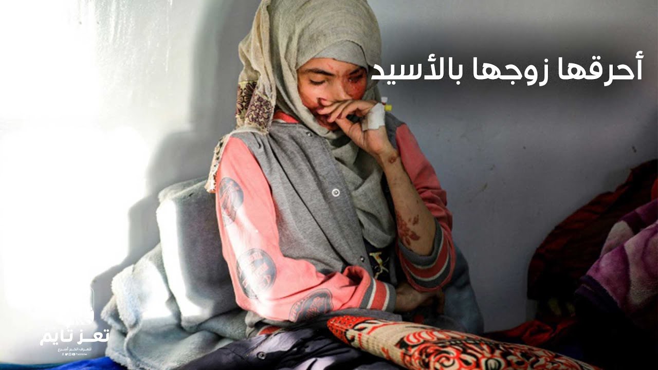 مأساة فتاة يمنية أحرقها زوجها بالأسيد وهو يضحك
